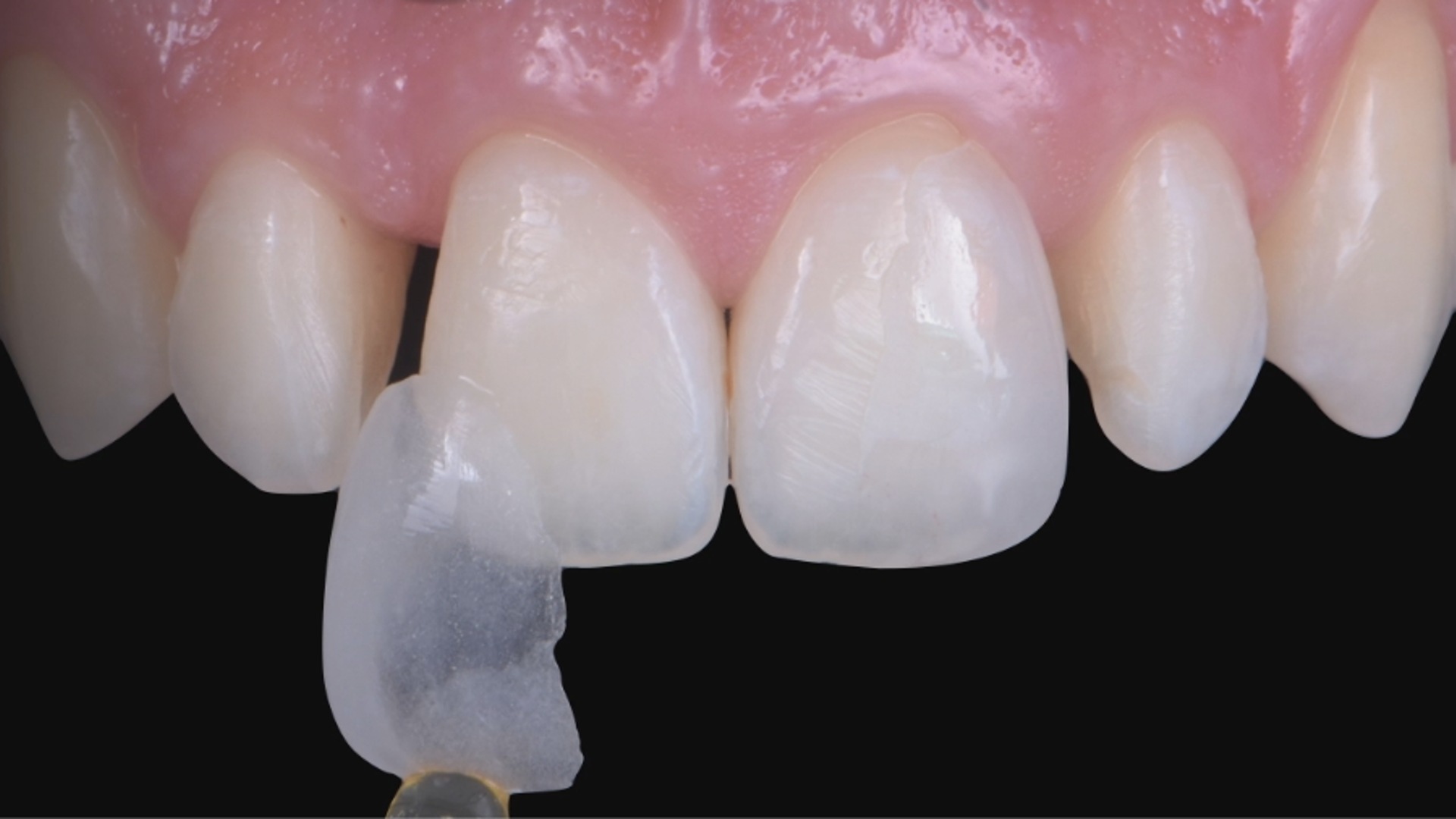 MIPP 0: clinical cases and No-prep veneers procedures