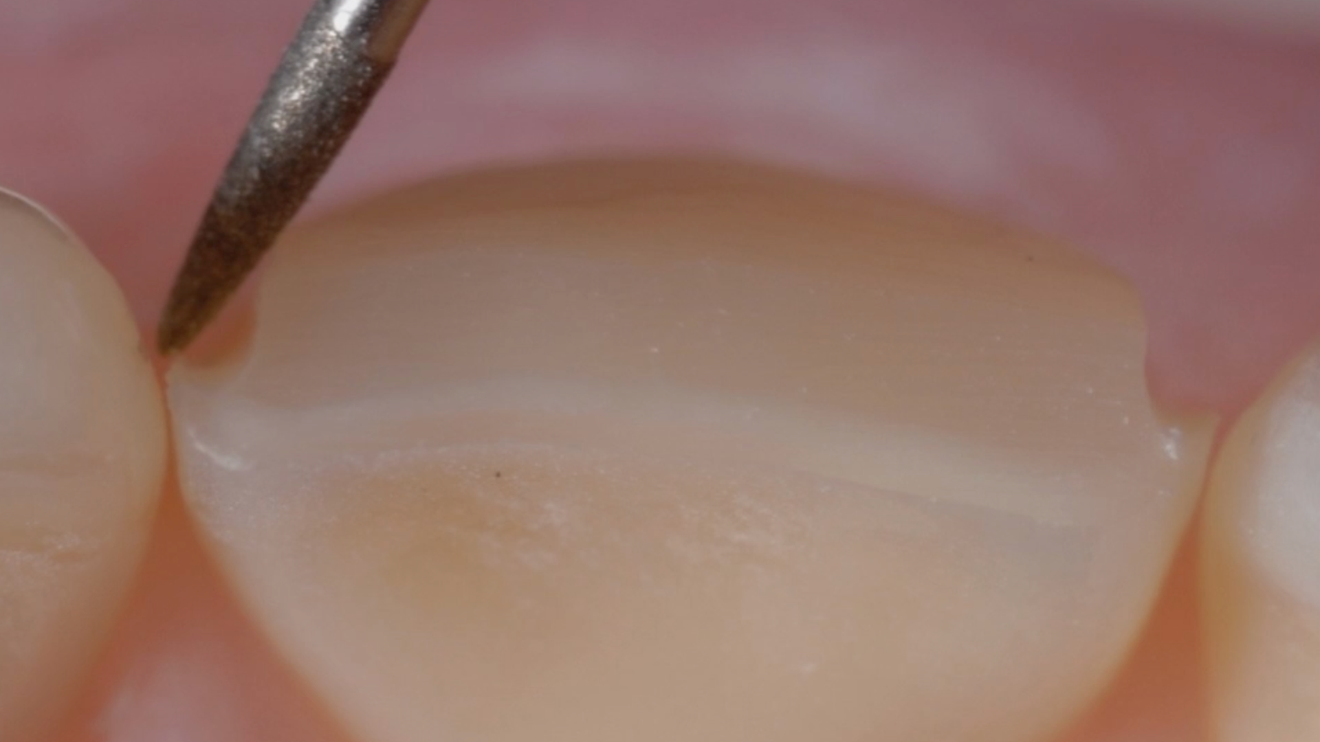  Clinical case - MIPP 1: conventional buccal veneers procedures