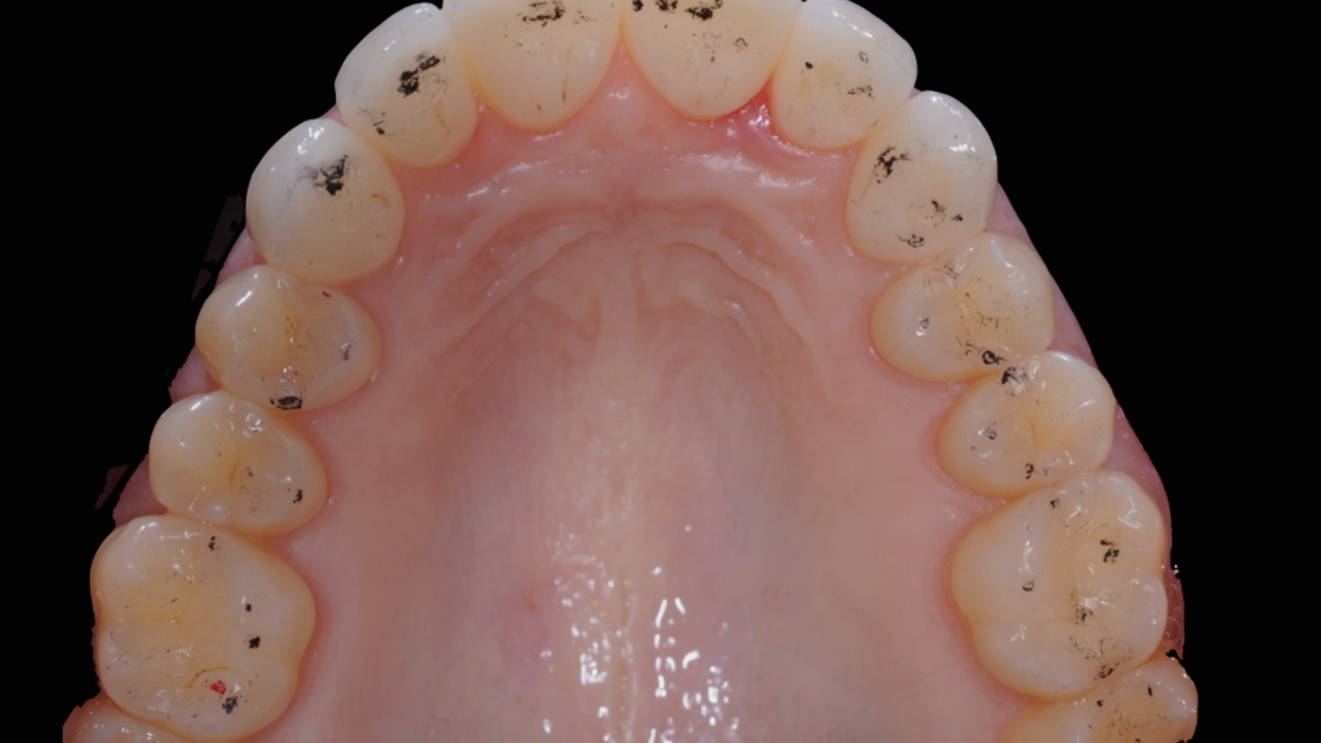  Clinical case - MIPP 3: occlusal parameters alteration