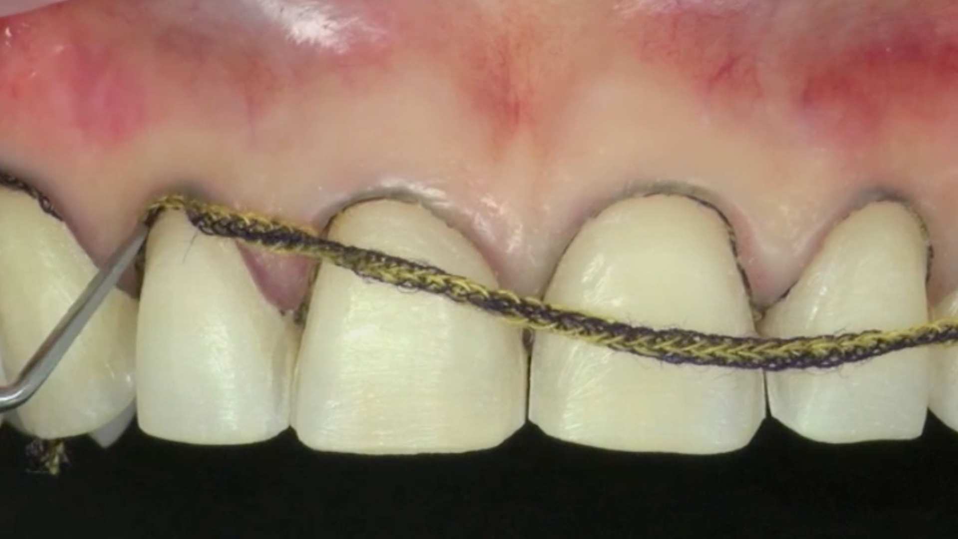 Clinical case - MIPP 3 (part 2 of 3): dental impression and provisional management