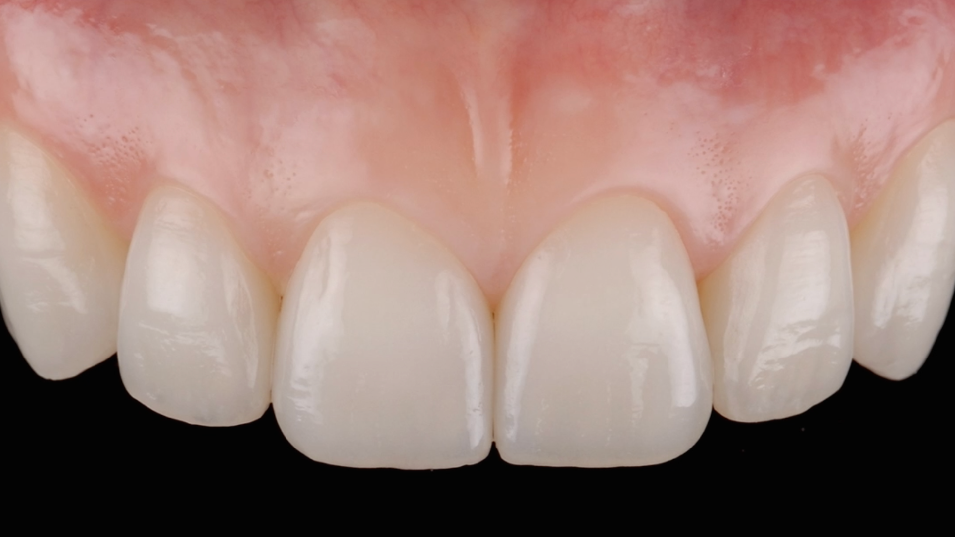 Clinical case - MIPP 3 (part 3 of 3): finalisation, restorations construction and cementation