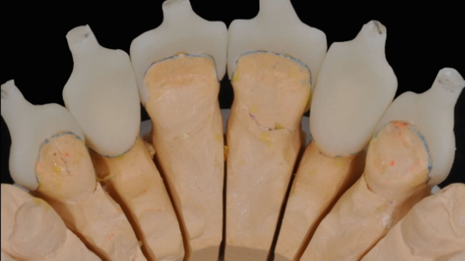 MIPP 2: the new concept behind Full-Veneers to optimise aesthetics and functionality