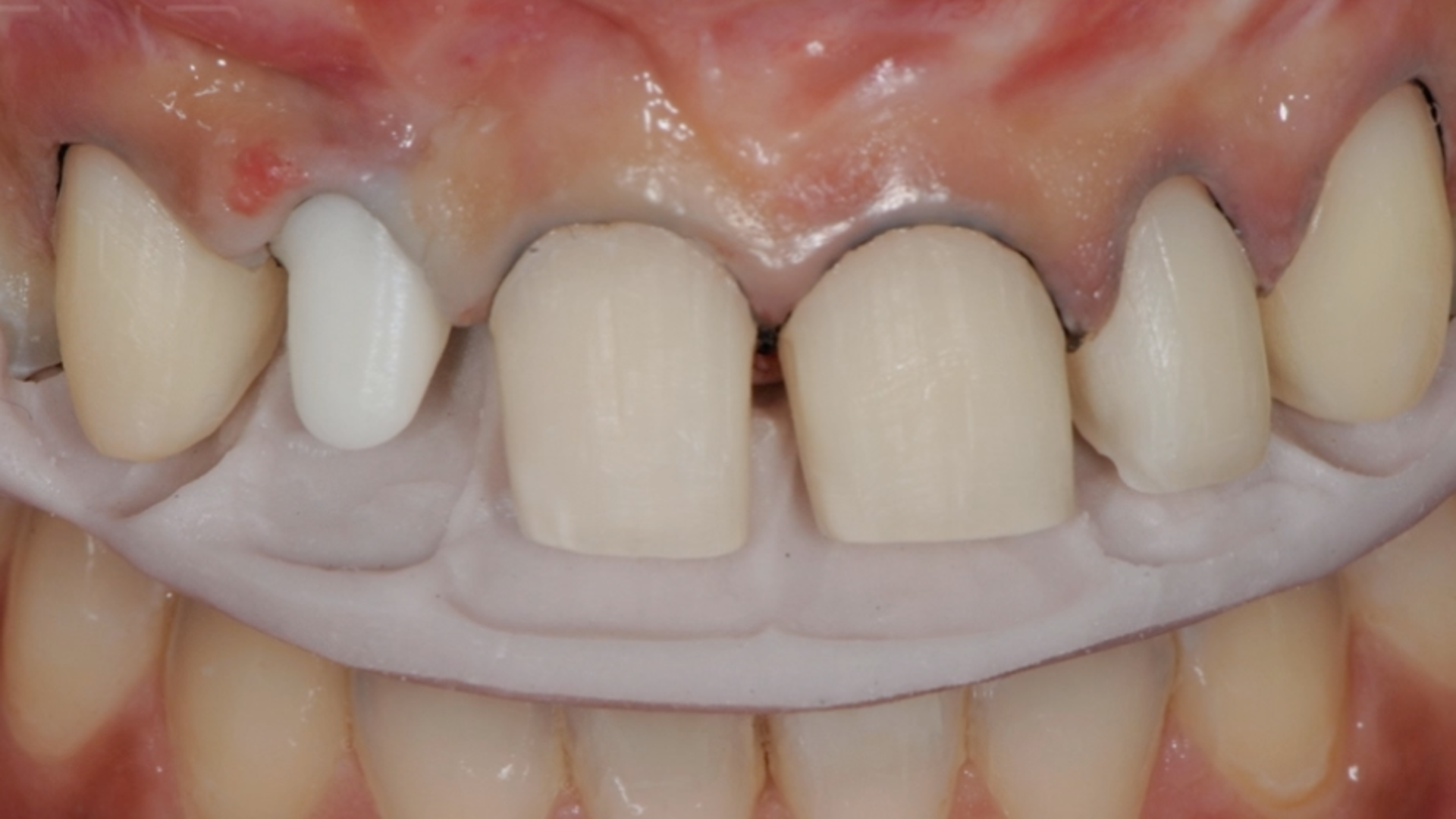  MIPP 2B: clinical case of Full-Veneers in openbite with preserved enamel tooth structure