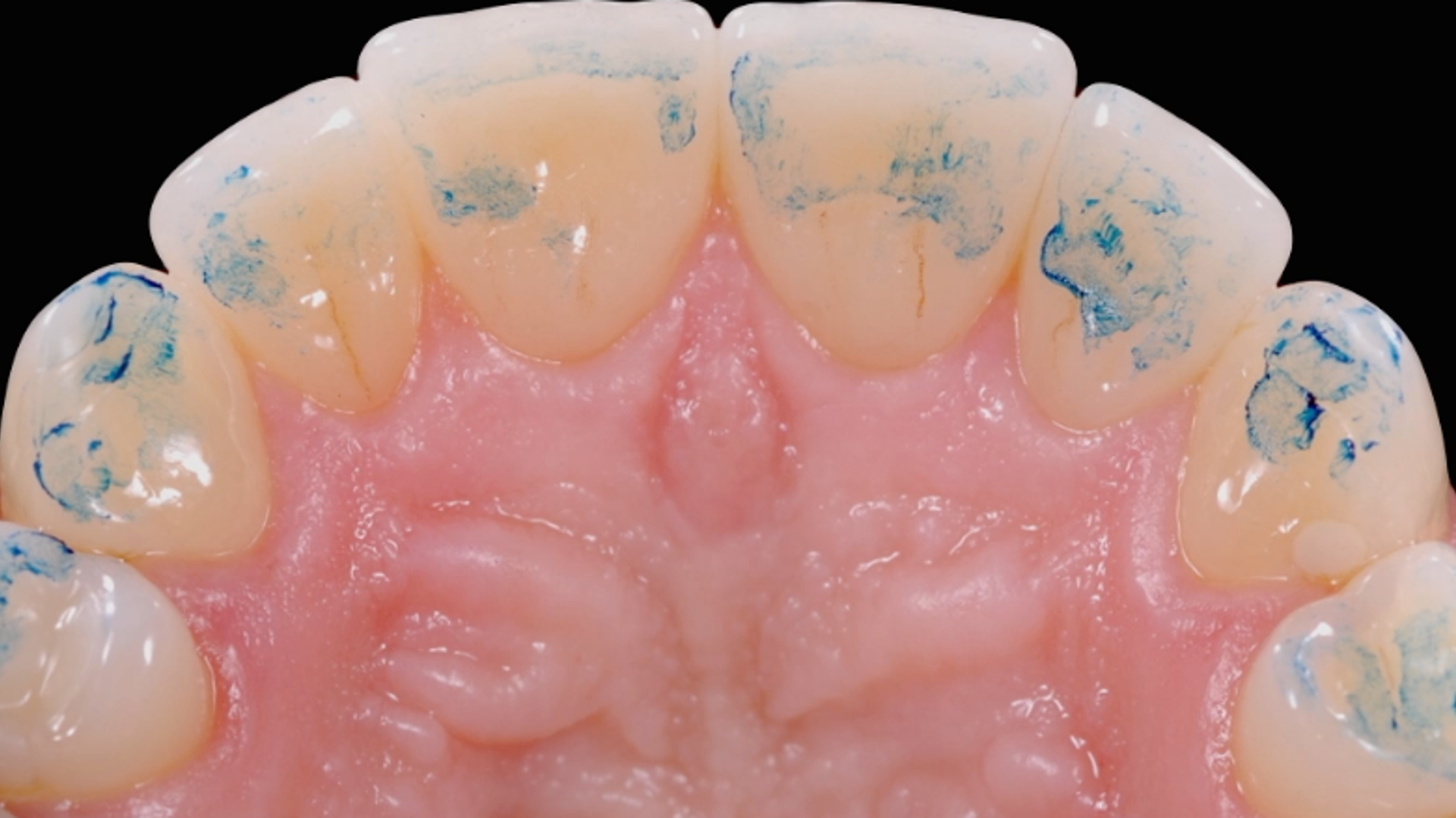  MIPP 2: MIPP 2A and MIPP 2B combined technique