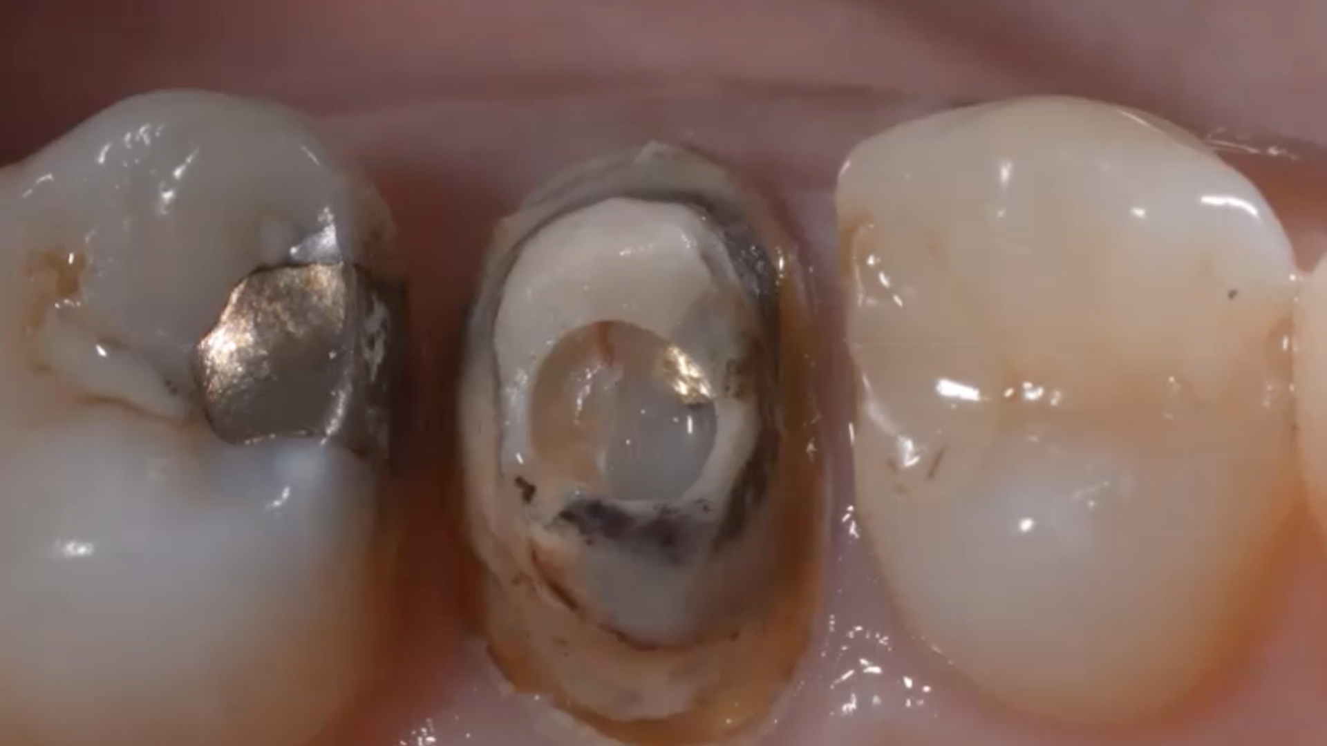 Coronal disassembly: removal of crowns and bridges