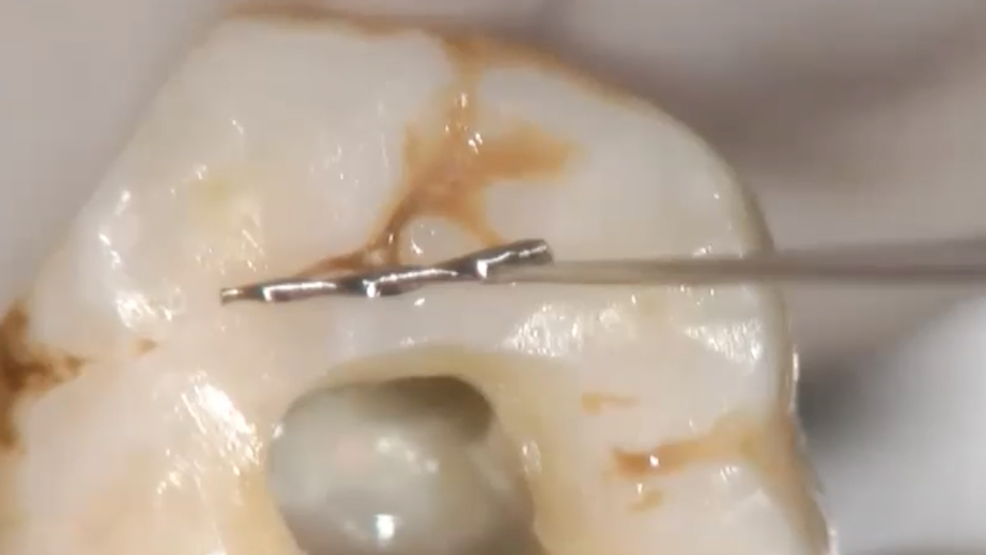 Treatment of fractured fragments