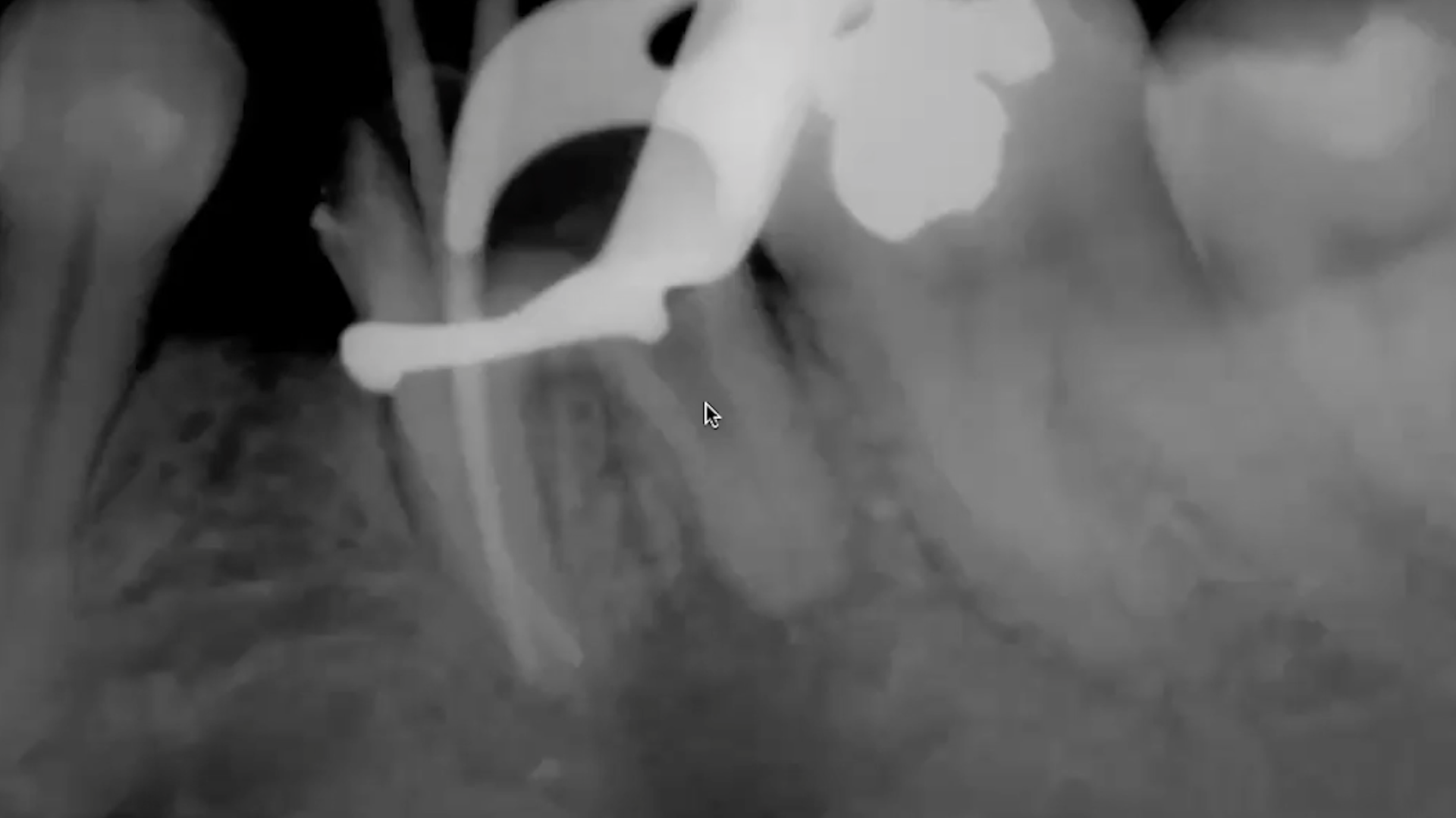 Repair of altered apical anatomy and open apex